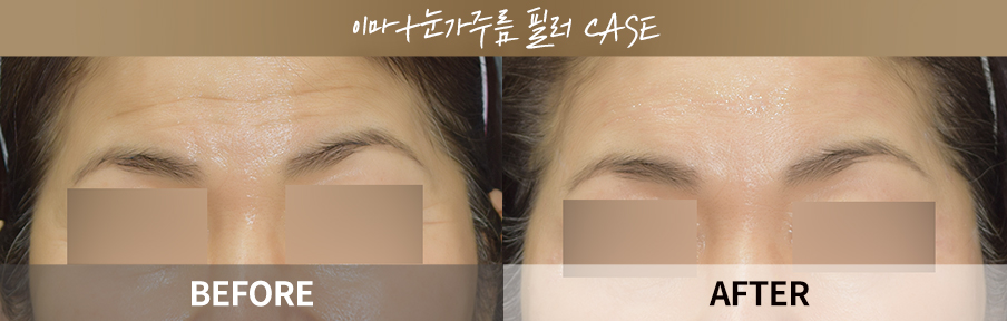 ภาพเปรียบเทียบก่อนและหลังทำ One Day Return Lifting 1