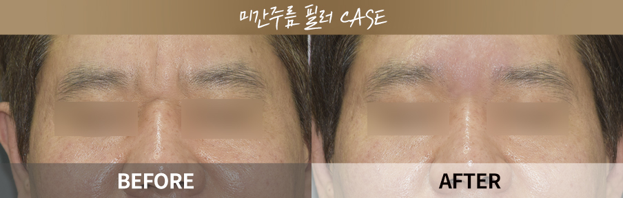 ภาพเปรียบเทียบก่อนและหลังทำ One Day Return Lifting 2