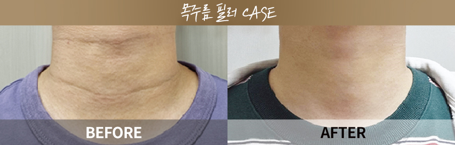 ภาพเปรียบเทียบก่อนและหลังทำ One Day Return Lifting 3