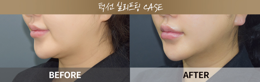 ภาพเปรียบเทียบก่อนและหลังทำ One Day Return Lifting 4