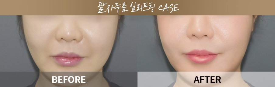 ภาพเปรียบเทียบก่อนและหลังทำ One Day Return Lifting 5