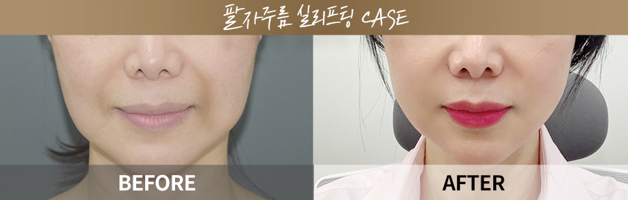 ภาพเปรียบเทียบก่อนและหลังทำ One Day Return Lifting 6