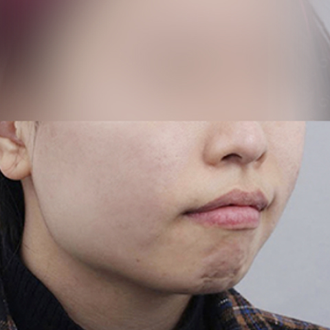 ภาพหลังทำทันที โปรแกรมรักษาสิวและรอยแผลเป็นจากสิว สำหรับโมบายล์ 1