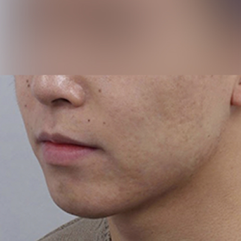 ภาพหลังทำทันที โปรแกรมรักษาสิวและรอยแผลเป็นจากสิว สำหรับโมบายล์ 2