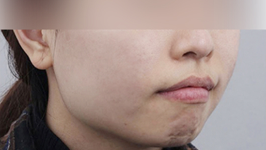 ภาพหลังทำทันที โปรแกรมรักษาสิวและรอยแผลเป็นจากสิว 1