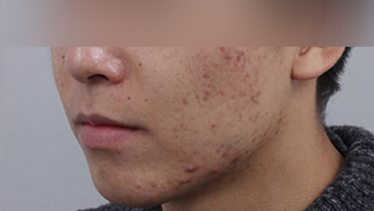 ภาพก่อนทำ โปรแกรมรักษาสิวและรอยแผลเป็นจากสิว 2