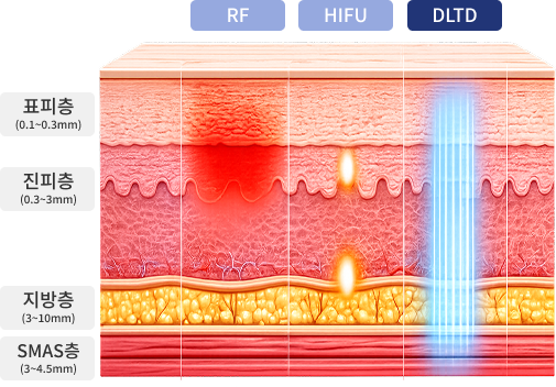 ภาพเปรียบเทียบการส่งพลังงานไปยังชั้นผิวระหว่าง RF, HIFU, DLTD