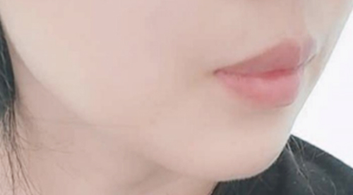 หลังลดเหนียงคางสองชั้น