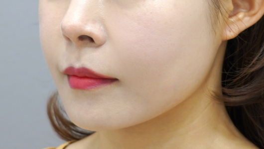 ภาพหลังทำหัตถการ Coolfase ครั้งที่ 3 - 4
