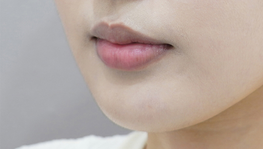 ก่อนทำฟิลเลอร์ปาก (ประเภทริมฝีปากม้วนเข้า)