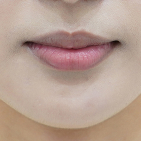 ก่อนทำฟิลเลอร์ปาก (ประเภทริมฝีปากม้วนเข้า)