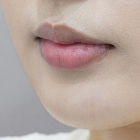 ก่อนทำฟิลเลอร์ปาก (ประเภทริมฝีปากม้วนเข้า)