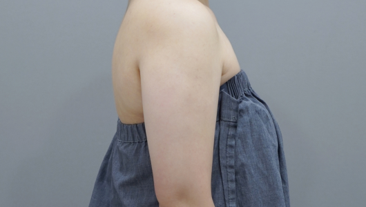 ภาพทันทีหลังทำ Onda Lifting บริเวณสัดส่วนร่างกาย 2
