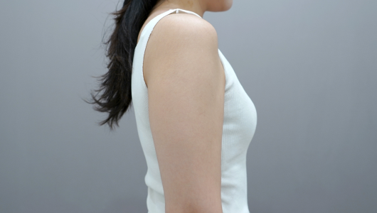 ภาพก่อนทำ Onda Lifting บริเวณสัดส่วนร่างกาย 1