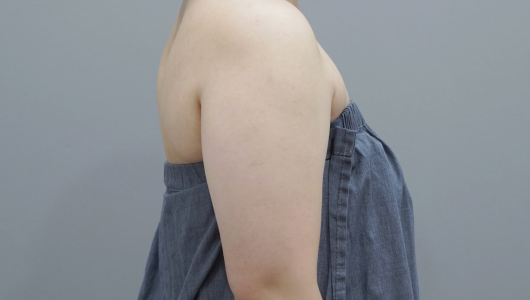 ภาพก่อนทำ Onda Lifting บริเวณสัดส่วนร่างกาย 2