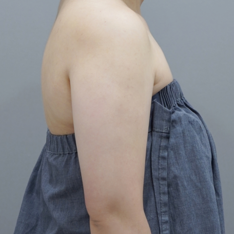 ภาพบนมือถือทันทีหลังทำ Onda Lifting บริเวณสัดส่วนร่างกาย 2