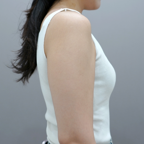 ภาพบนมือถือก่อนทำ Onda Lifting บริเวณสัดส่วนร่างกาย 1