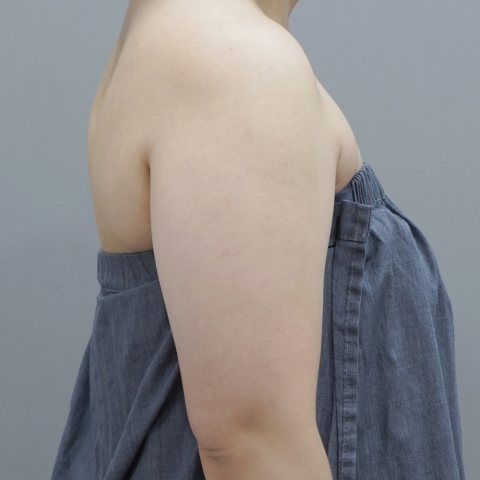 ภาพบนมือถือก่อนทำ Onda Lifting บริเวณสัดส่วนร่างกาย 2