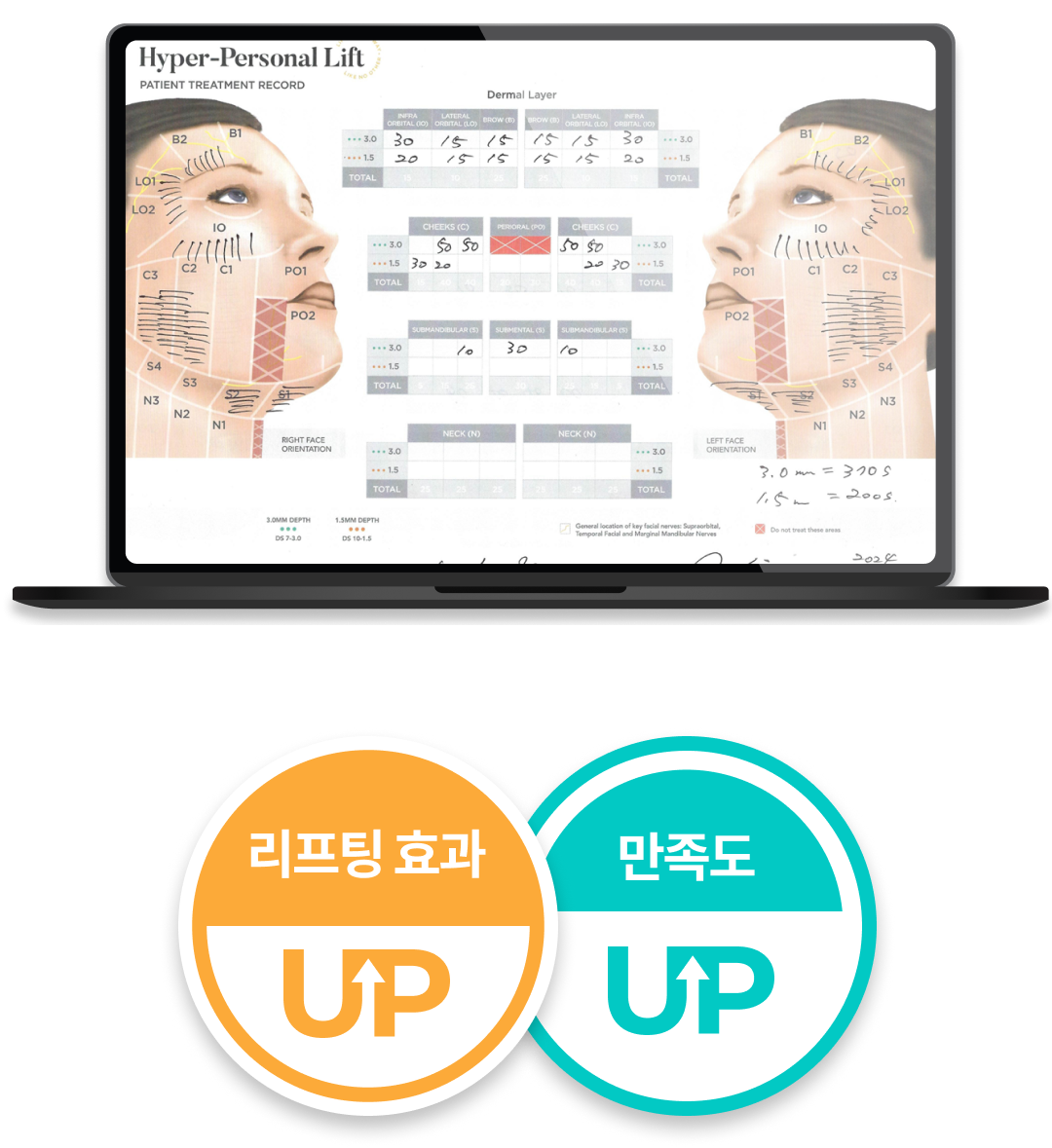 ภาพบนมือถืออธิบายหัตถการ Ultherapy Prime หมดกังวลเรื่องแก้มตอบ