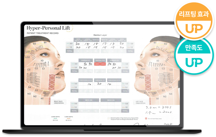 ภาพอธิบายการออกแบบหัตถการ Ultherapy Prime หมดกังวลเรื่องแก้มตอบ